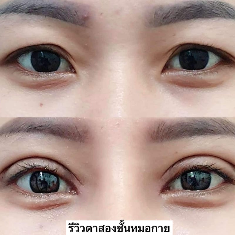 การทำตาสองชั้น