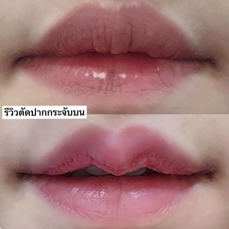 ศัลยกรรมปากกระจับ