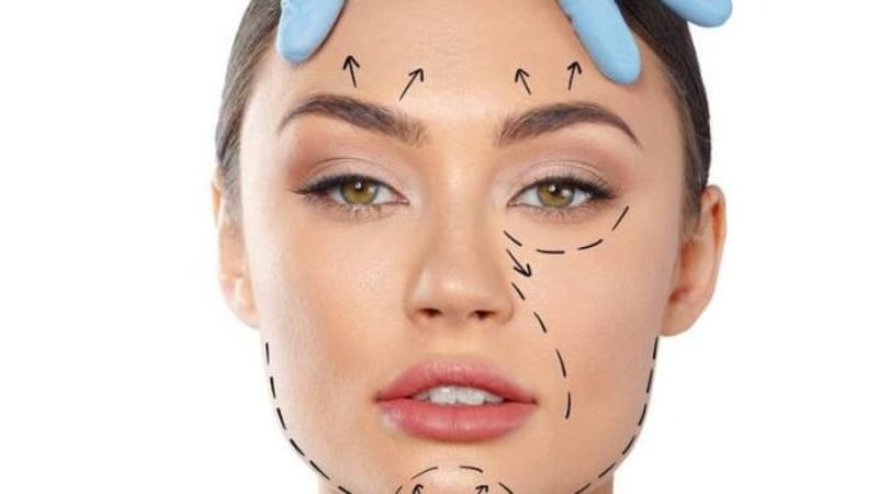 Is the Brow Lift Cost in Vietnam Worth It? Results and Patient Reviews