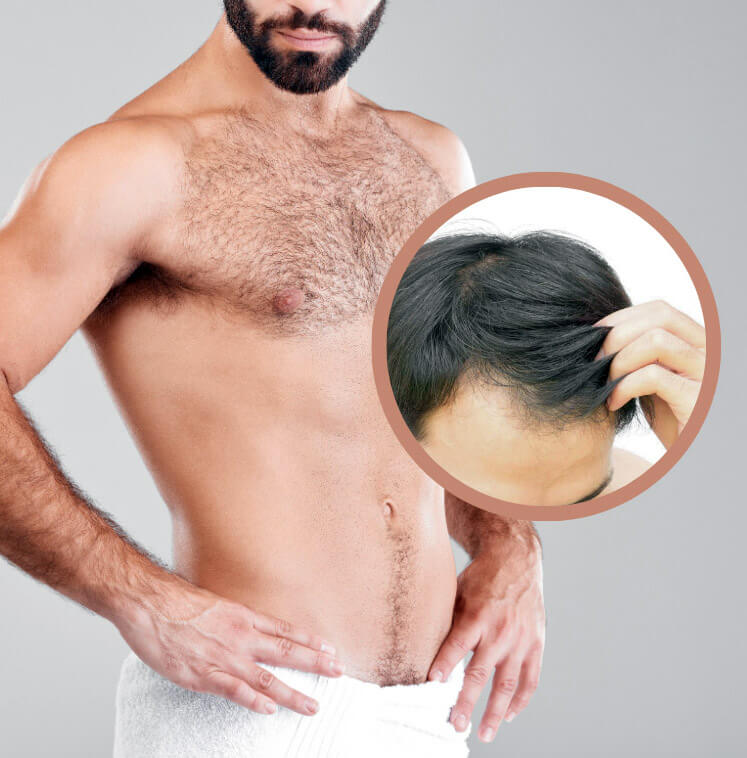 Beard vs. Chest Hair: Can Body Hair Be Transplanted to Scalp Safely?