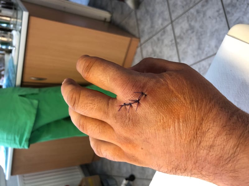 Kézsérülések a munkahelyen – hogyan előzhetjük meg a leggyakoribb baleseteket?