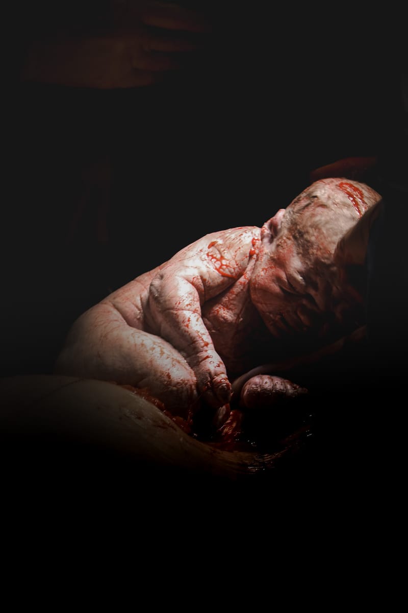 C-Section