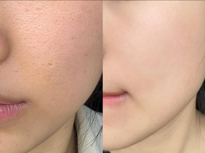 COMBO 1_XÓA THÂM MẮT - CẤP ẨM TẾ BÀO - TĂNG SINH COLLAGEN