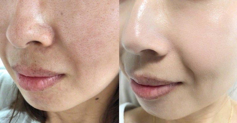 COMBO 2_CĂNG BÓNG - TRẮNG SÁNG - TRẺ HÓA DÂY CHẰNG TOÀN MẶT