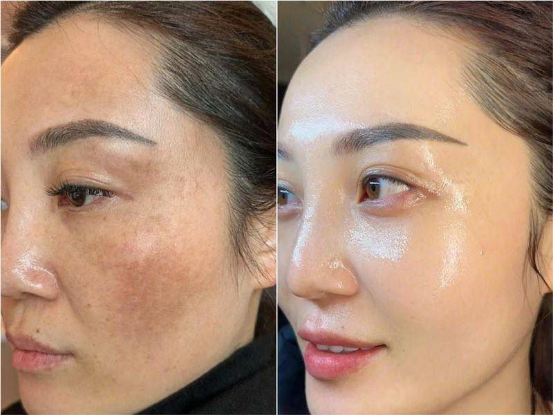 COMBO 6_MESO TRỊ NÁM - TRẮNG SÁNG - XOÁ NHĂN - TRẺ HOÁ MÔI - TĂNG SINH COLLAGEN