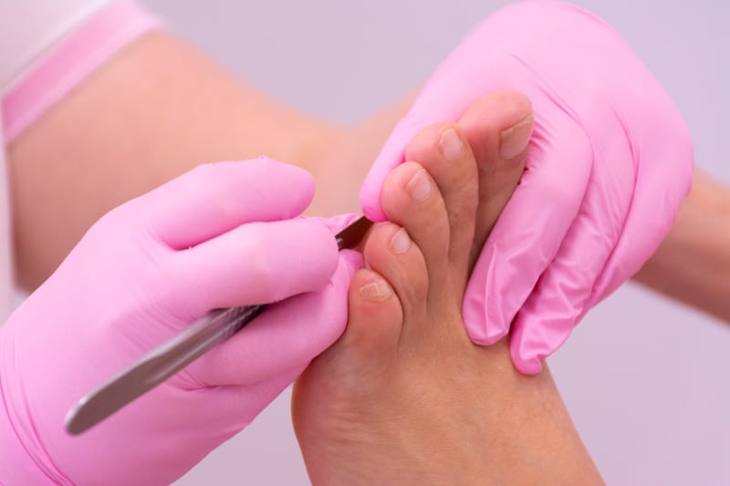 Tyúkszem eltávolítás