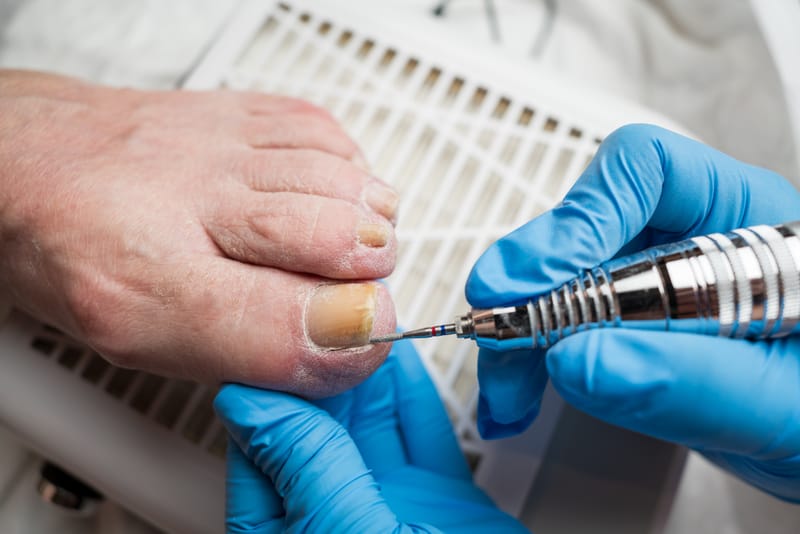 Benőtt köröm kezelés