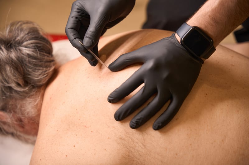 Acupunctuur bij migraine en hoofdpijn