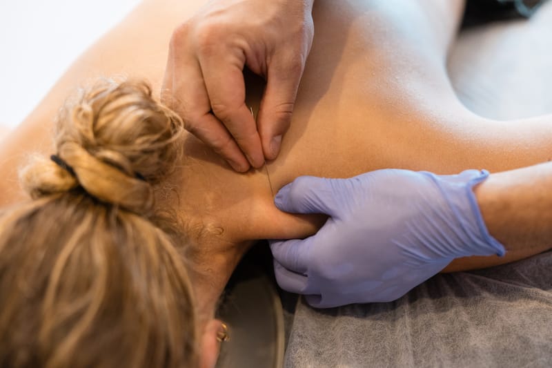 Dry needling vs acupunctuur: wat is het verschil?