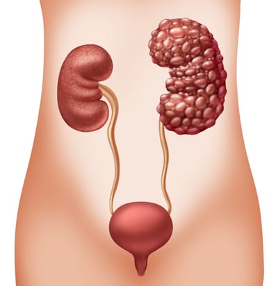 Polikistik Böbrek Hastalığı Nedir?