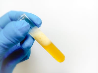 İdrarda Köpürme = Protein Kaçağı mı?