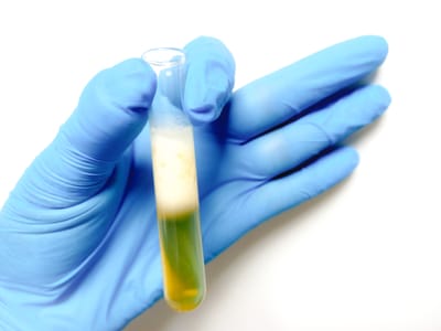 Protein Kaçağı (Proteinüri) Nedir? Ne Zaman Şüphelenilmeli?