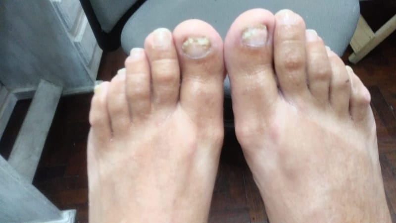 Implantes Temporales