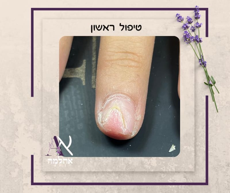 אוניכוליזיס, מה זה?