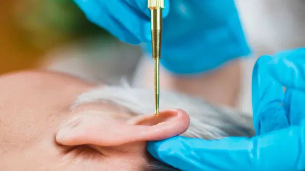 Les Bienfaits de l'Auriculothérapie