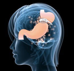 Séances hypnose Anneau gastrique virtuel