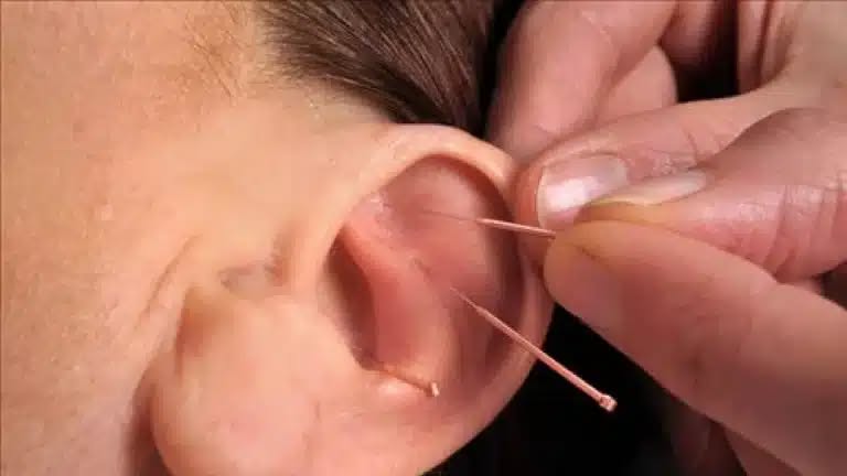 Qu'est-ce que l'Auriculothérapie ?