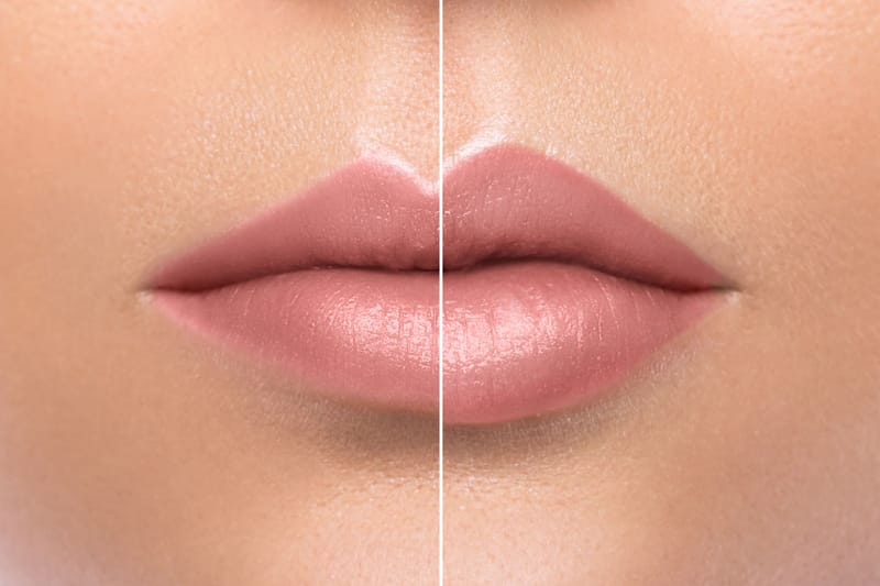 Lip Fillers