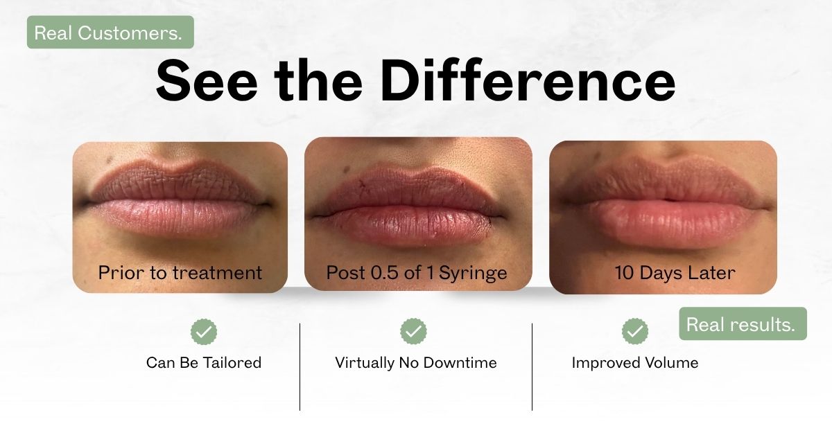 Lip Filler
