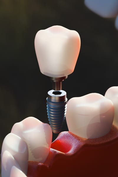 12 beneficios de los implantes dentales para salud, estética y calidad de vida