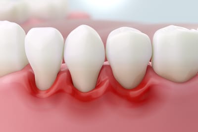 Del Sangrado de la Encía a la Pérdida de Dientes: La Línea del Tiempo de la Infección en tus Encías y sus consecuencias