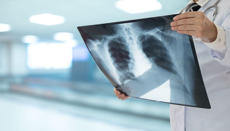 X-RAY