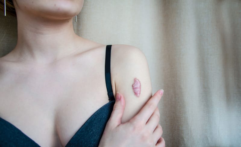 Keloid Scar Treatment