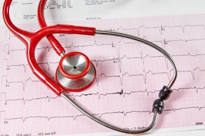 Fibrilação atrial: a arritmia silenciosa que prepara o terreno para o AVC