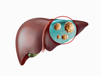 Esteatose hepática avança e já afeta crianças e adolescentes