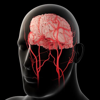 AVC na artéria cerebral média: por que a prevalência?
