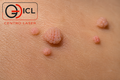 Verrugas por VPH: Genotipos, síntomas y tratamiento láser efectivo en ICL Centro Láser