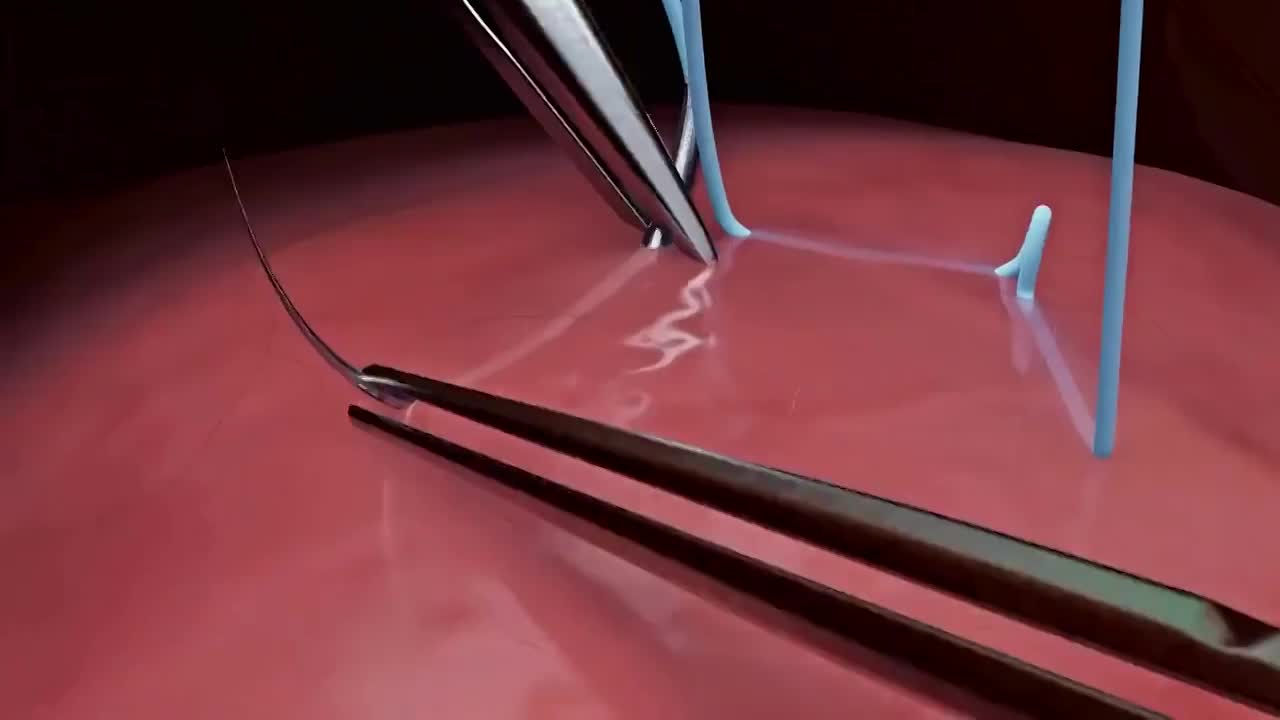 Minimally Invasive Surgery
