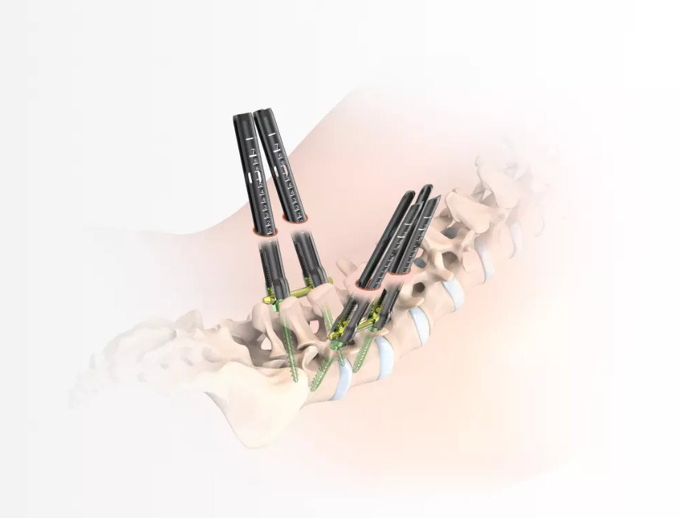 MS Posterior Spinal Fixation System