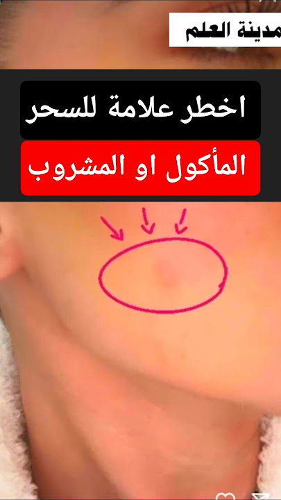 أبرز الأعراض التي تُنسب إلى السحر المأكول وضرورة التمييز بينها وبين الأمراض