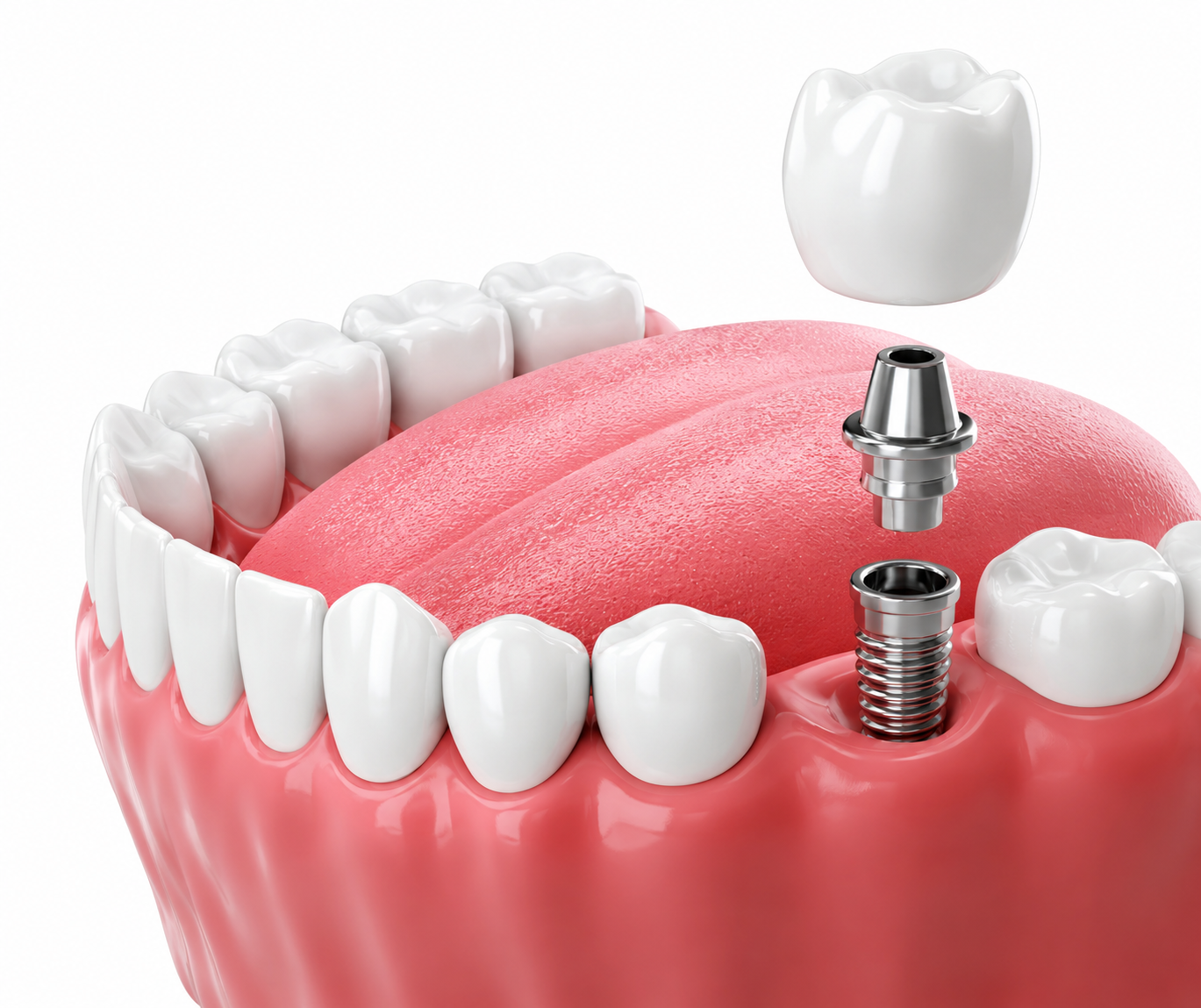 Implantes