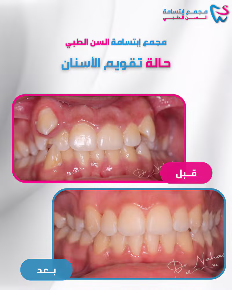 حالة تقويم الأسنان