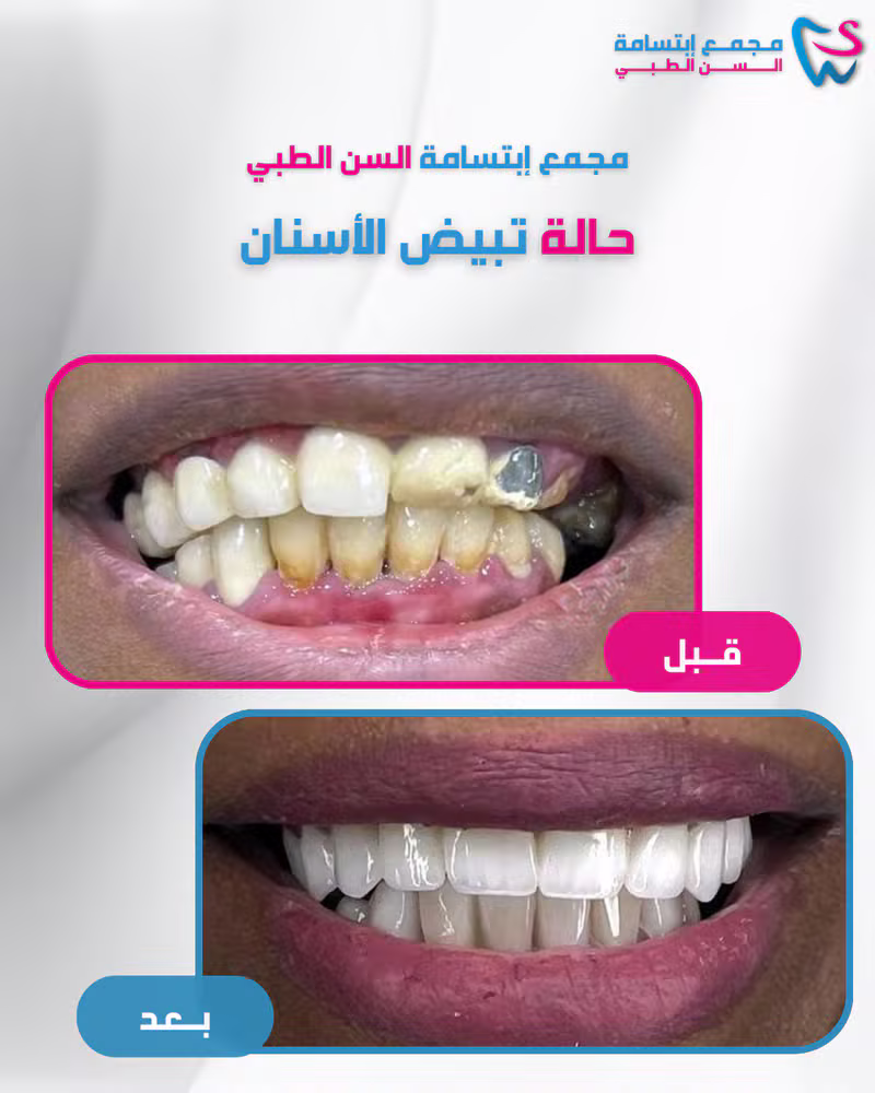 حالة تبييض الأسنان