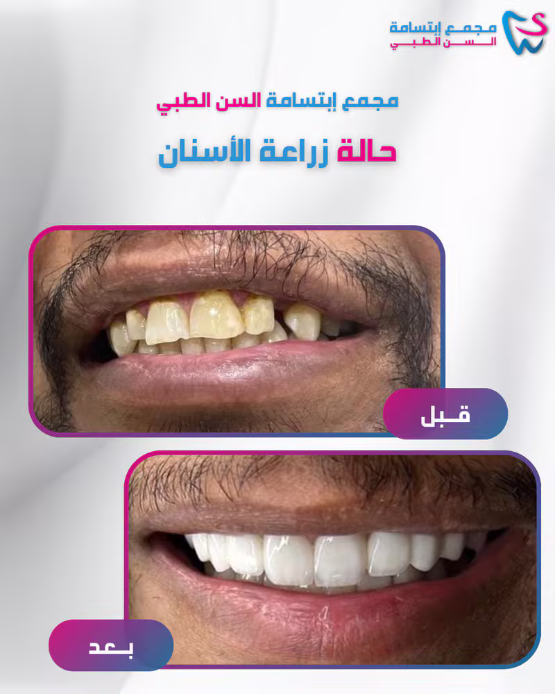 حالة زراعة الأسنان