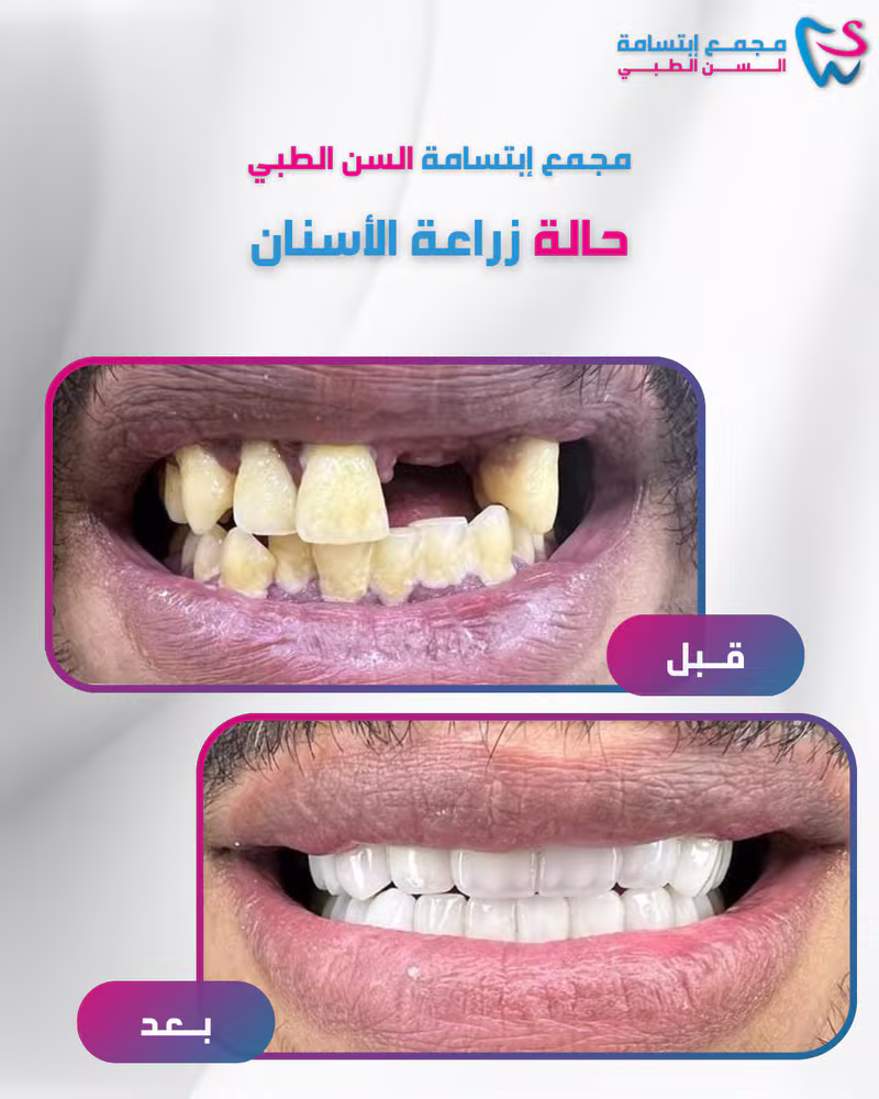 حالة زراعة الأسنان