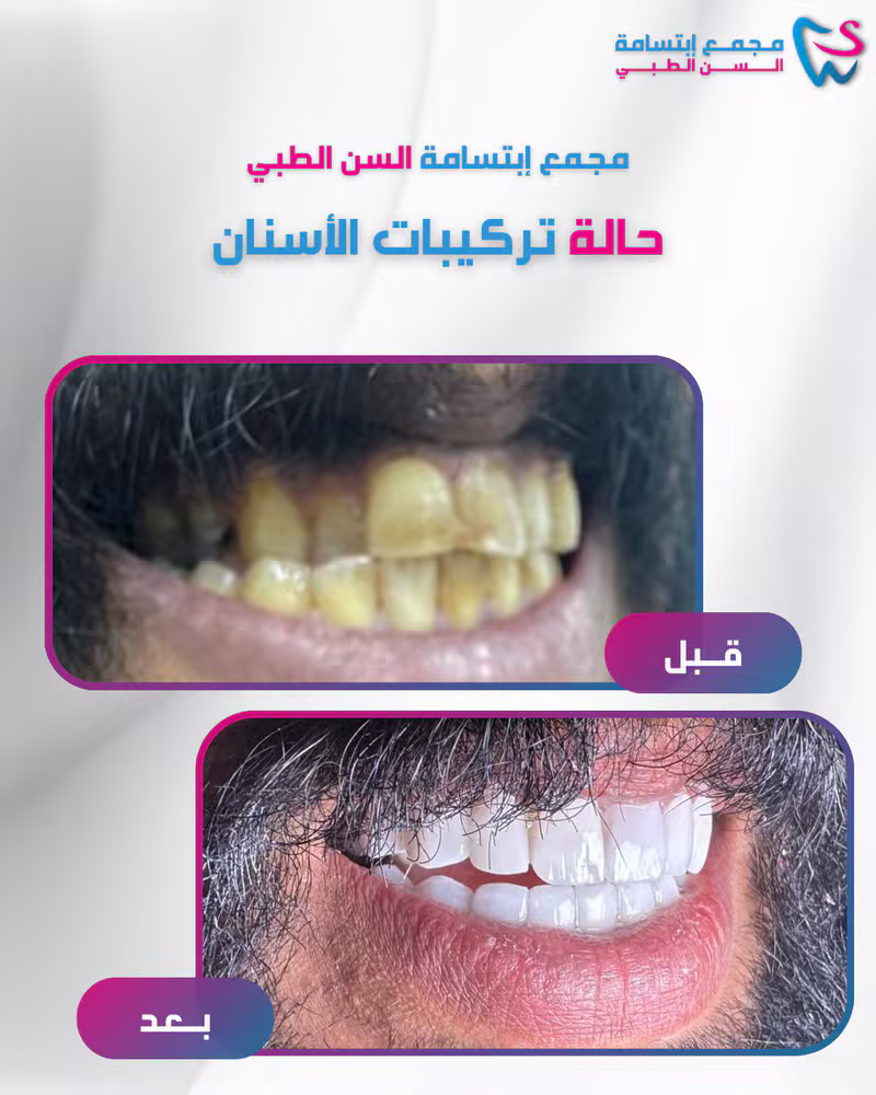 حالة تركيبات الأسنان
