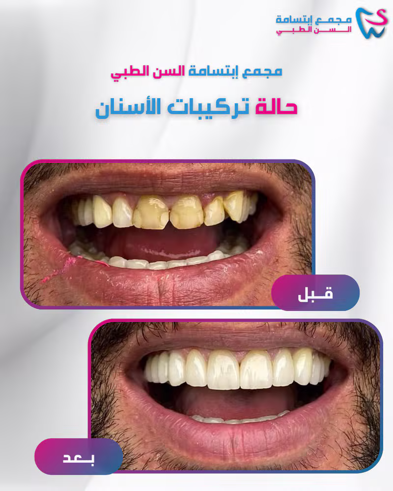حالة تركيبات الأسنان