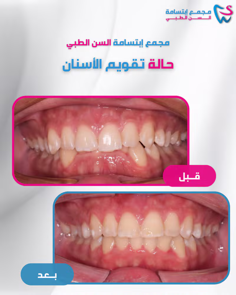 حالة تقويم الأسنان