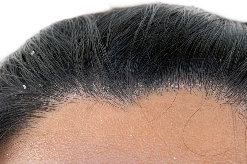15 Hair Replacement Myths Busted, What Really Happens With Nonsurgical Systems