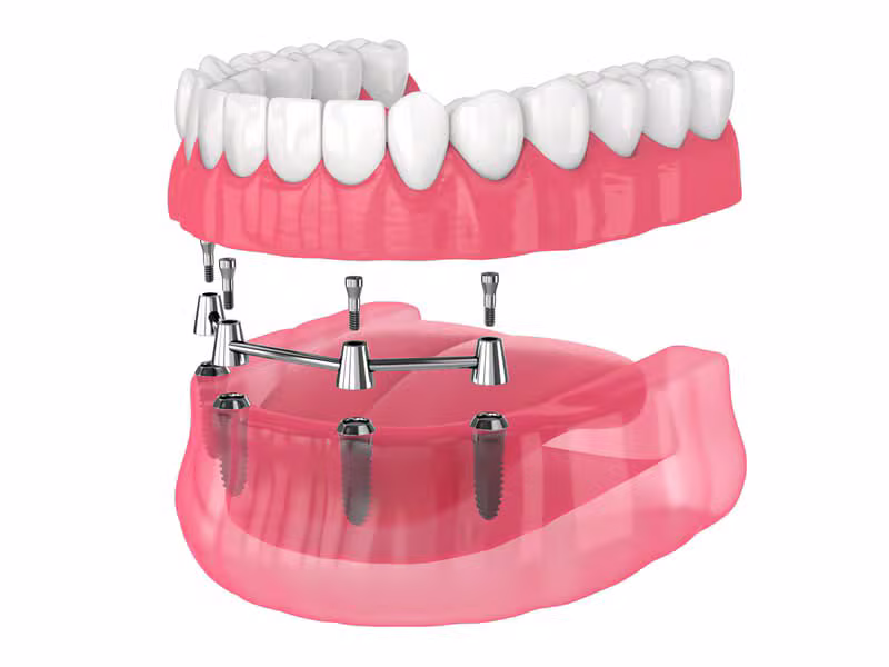 Prothèses sur Implants