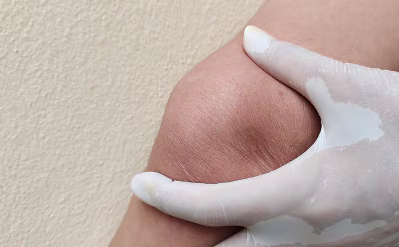 Postoperatorio de prótesis de rodilla (PTR): claves para una recuperación real