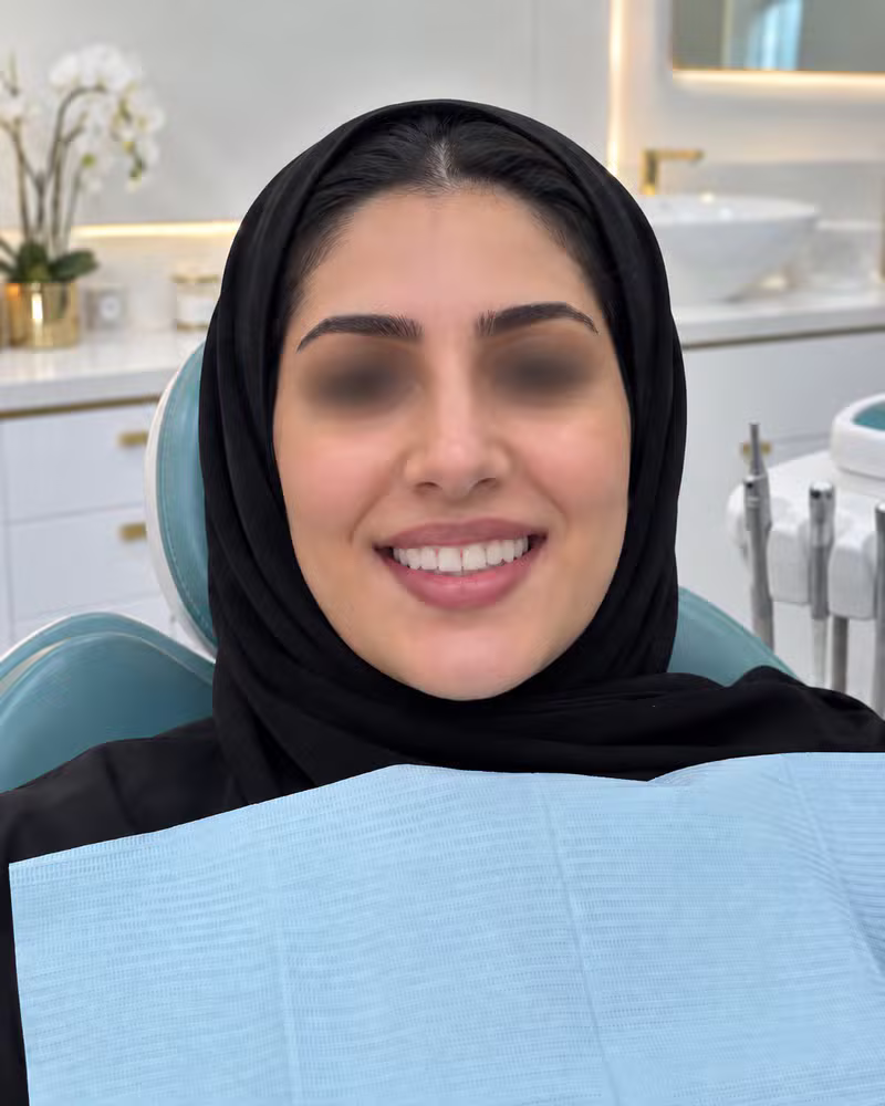 بعد ابتسامة هوليوود