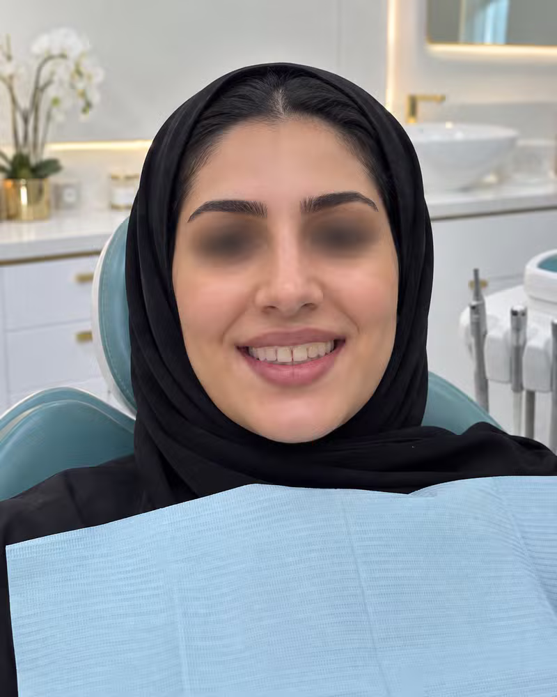 قبل ابتسامة هوليوود