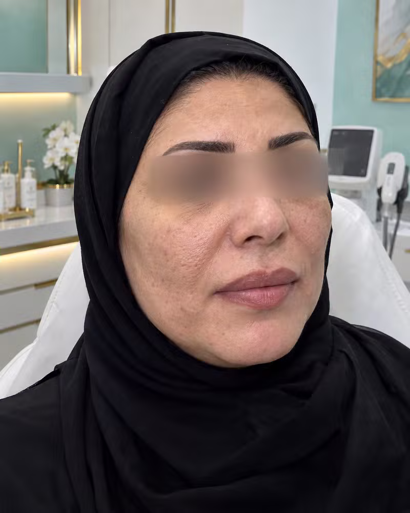 قبل علاج وتصفية البشرة