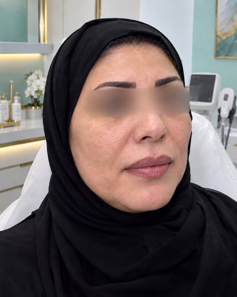 بعد علاج وتصفية البشرة