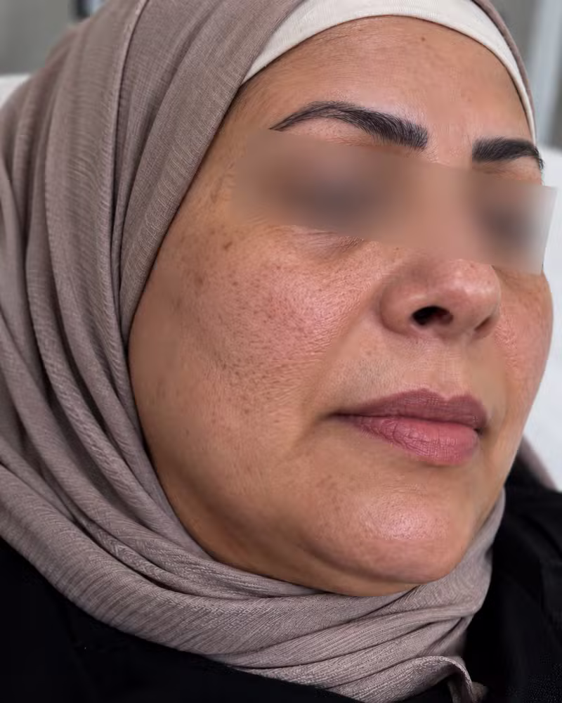 قبل ديرما بن
